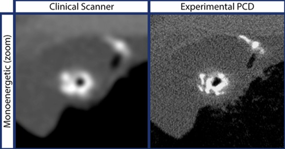 European Radiology (2020): imaging an excised human heart using a prototype silicon photon-counting CT detector